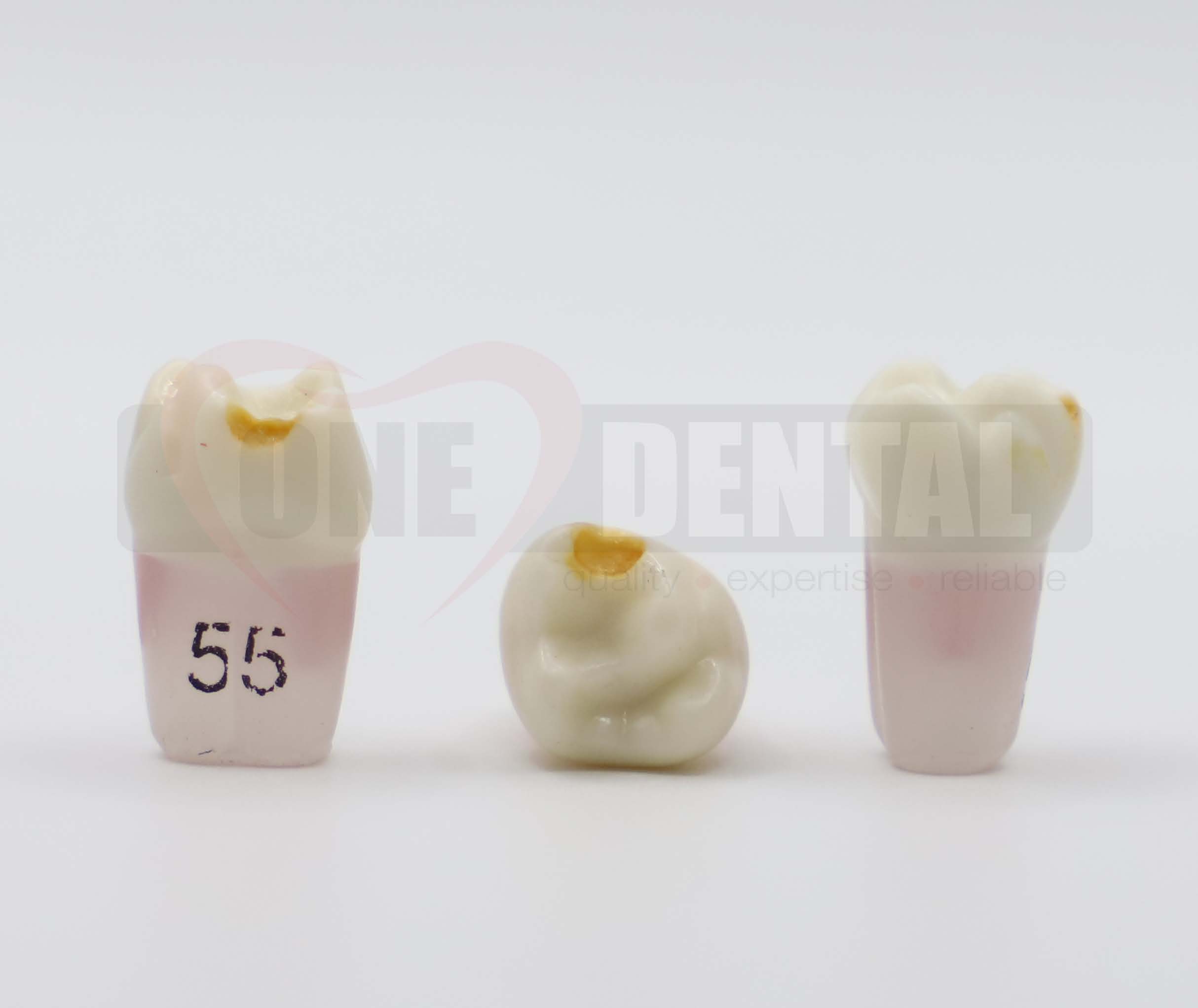 Pulpotomy Tooth 55 Prep & Stain + Screw for 1971 Paedo Model