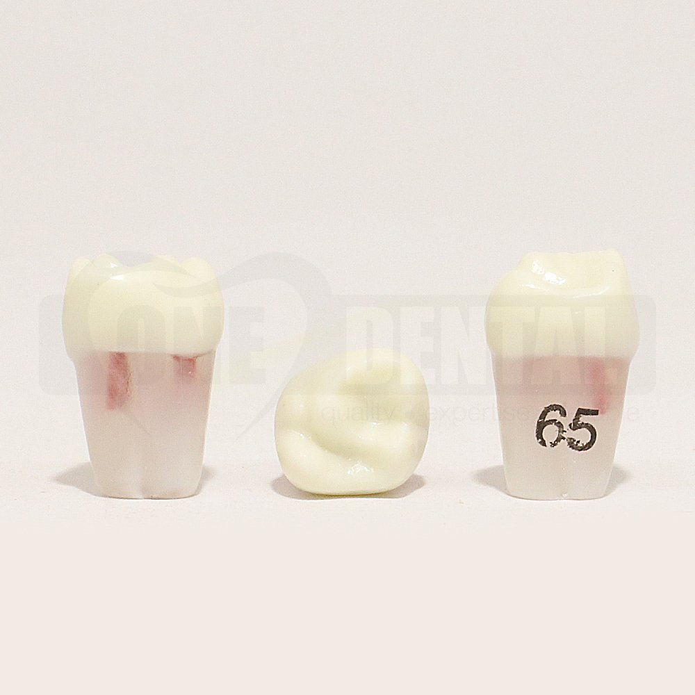 Pulpotomy Tooth 65 + Screw for 1971 Paedo Model