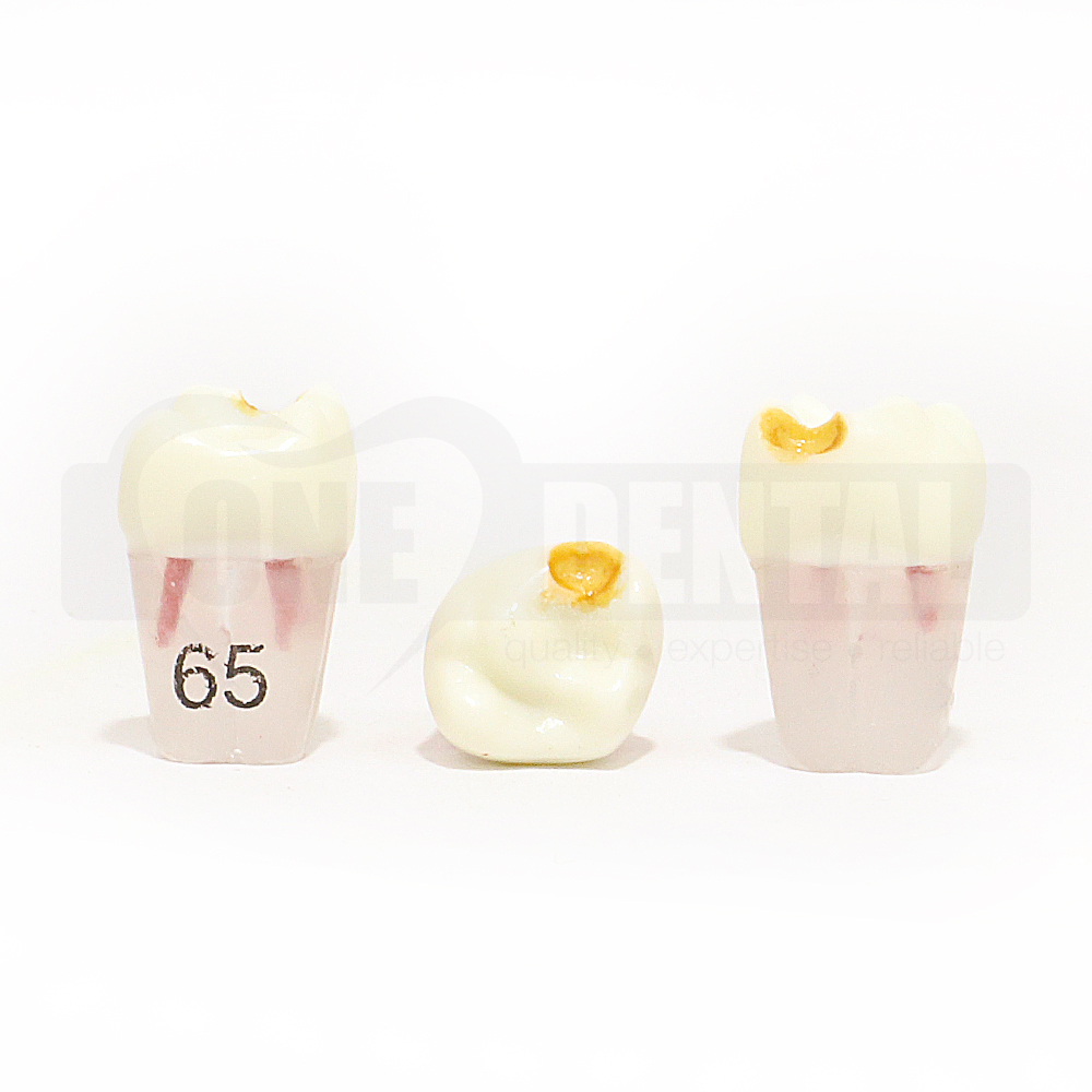 Pulpotomy Tooth 65 Prep & Stain +  Screw for 1971 Paedo Model