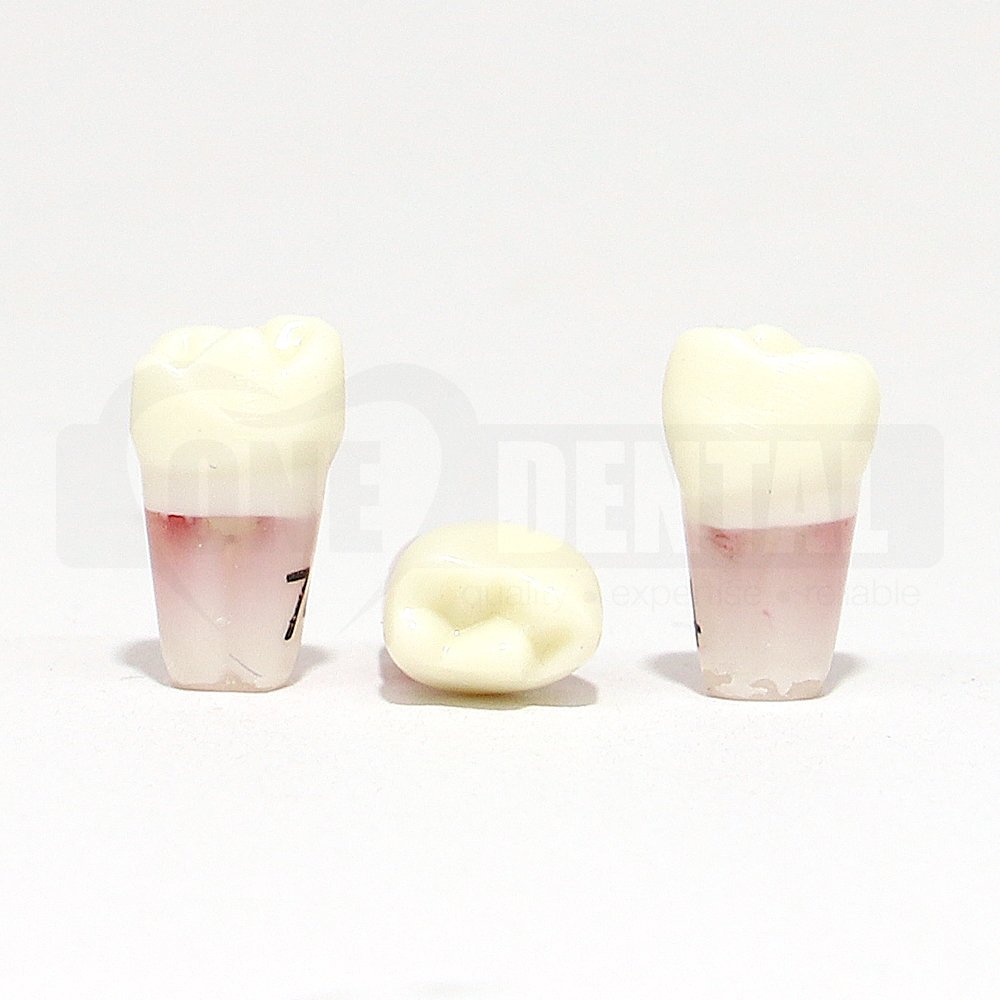 Pulpotomy Tooth 74 + Screw for 1971 Paedo Model