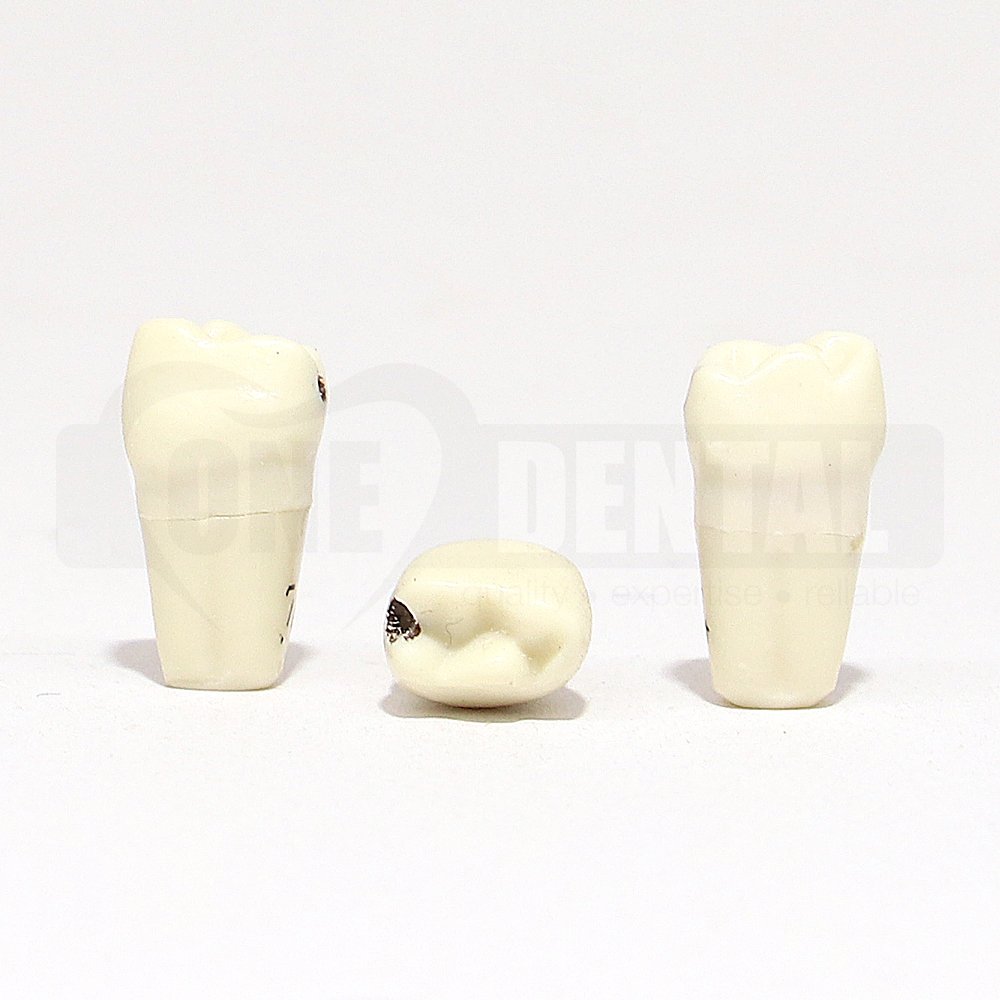 Pulpotomy Tooth 74 Prep & Stain + Screw for 1971 Paedo Model