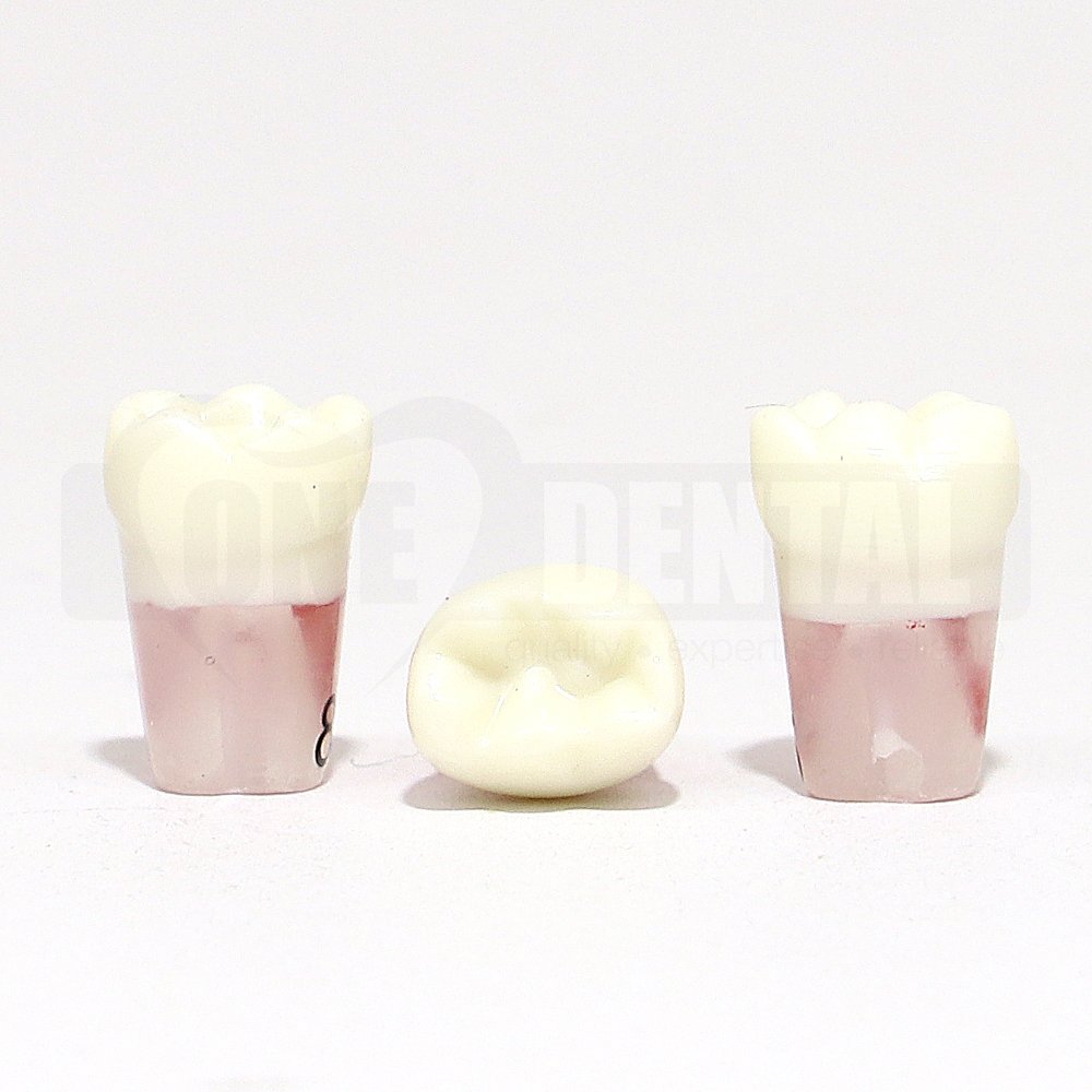 Pulpotomy Tooth 85 + Screw for 1971 Paedo Model