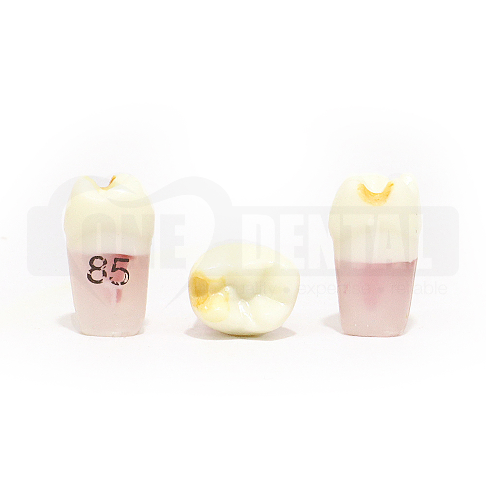 Pulpotomy Tooth 85 Prep & Stain + Screw for 1971 Paedo Model