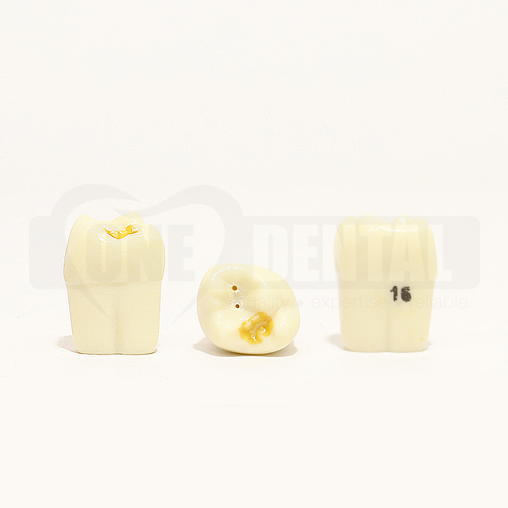 Hypomineralised Tooth 16 DM for 1974 Paedo Model