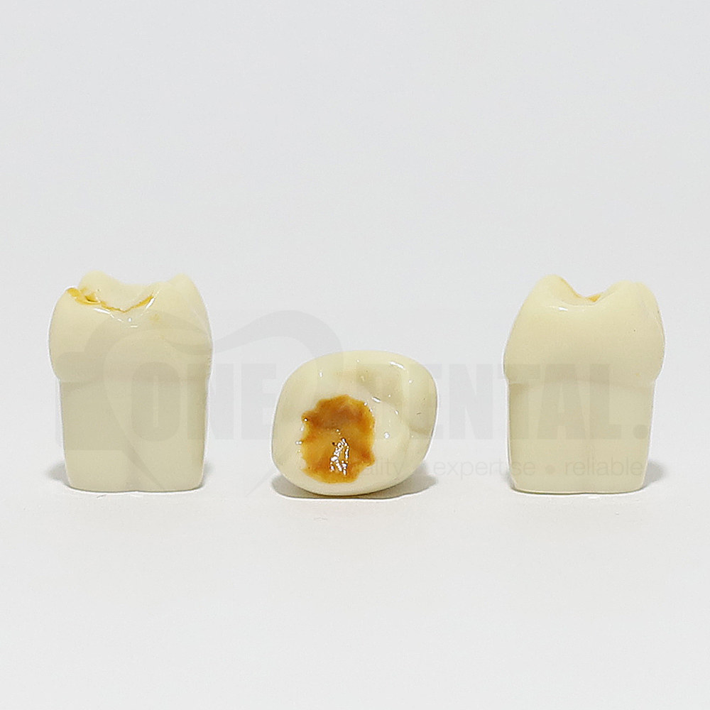 Hypomineralised Tooth 26 DM for 1974 Paedo Model