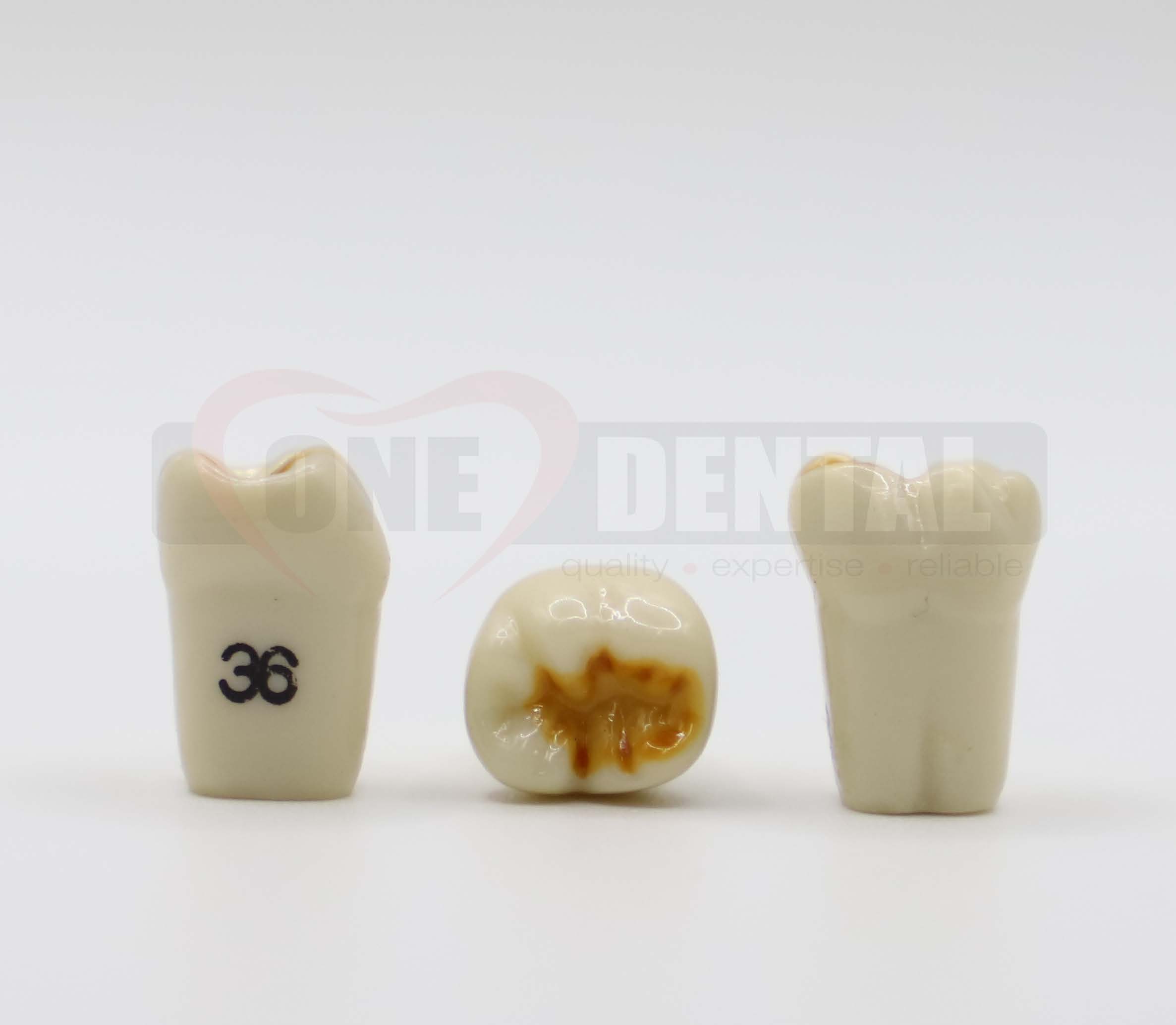 Hypomineralised Tooth 36 for 1971 Paedo Model