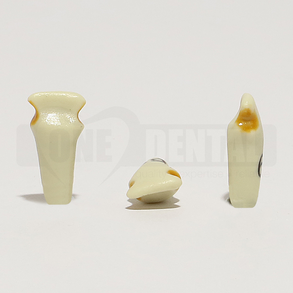 Caries Tooth 61 with Apple Core Caries for 1974 Paedo Model