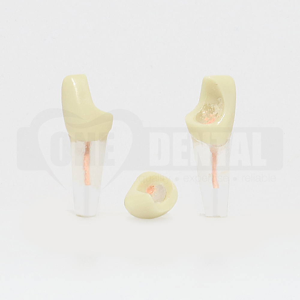 Tooth 11 Endo Gutta Percha Filled and Distal Cavity for 2008 Adult Model