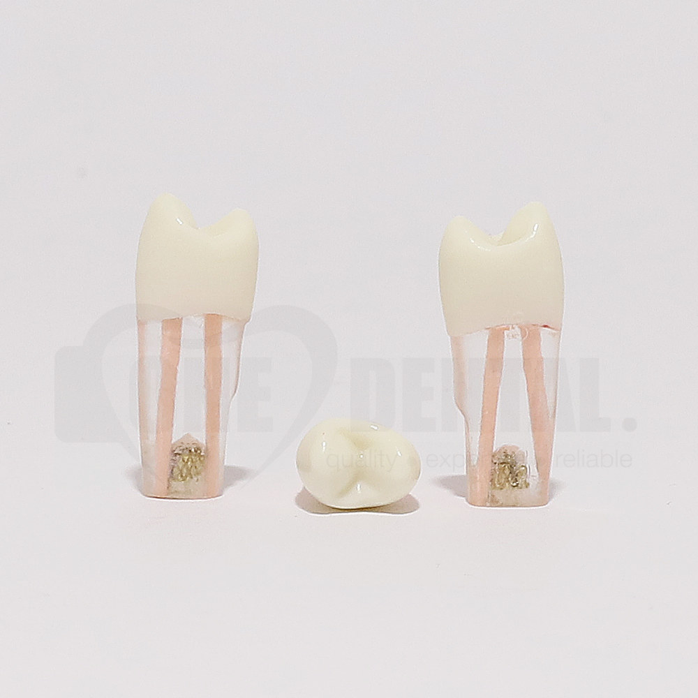 Tooth 25 Gutta Percha Filled for Post & Core with Crown for 2010 Adult Model