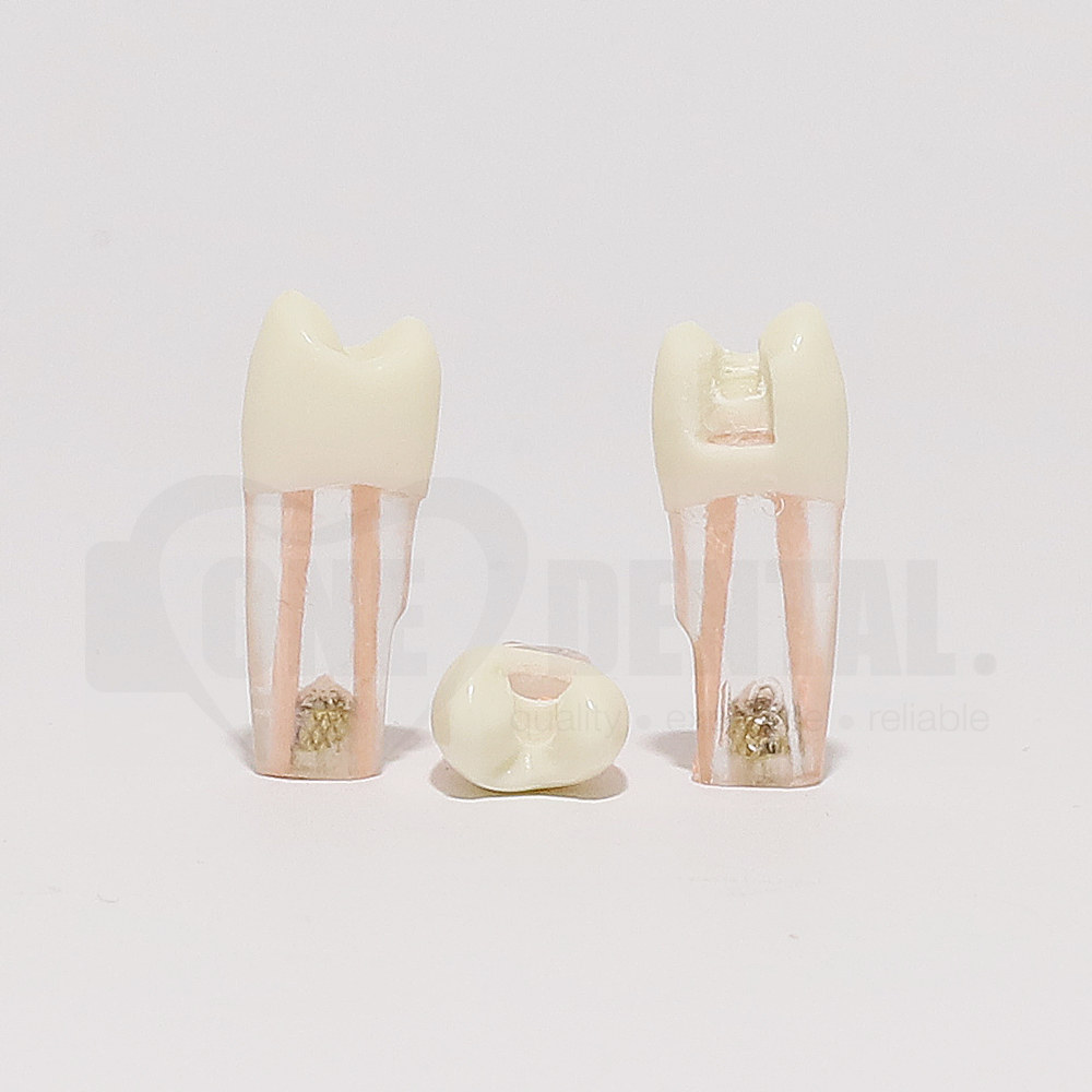 Tooth 25 Gutta Percha Filled for Post & Core with DO Cavity for 2010 Adult Model