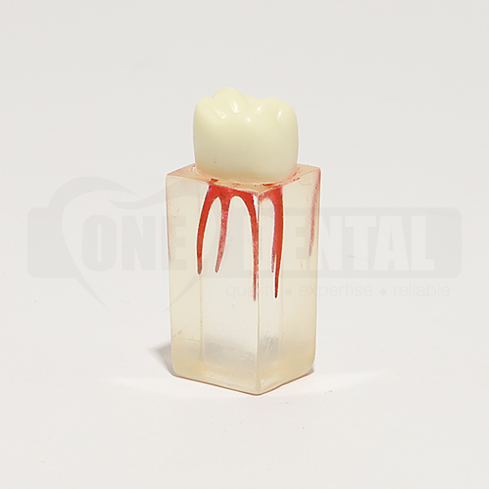 Root canal block U6 Molar Tooth 16 with Crown