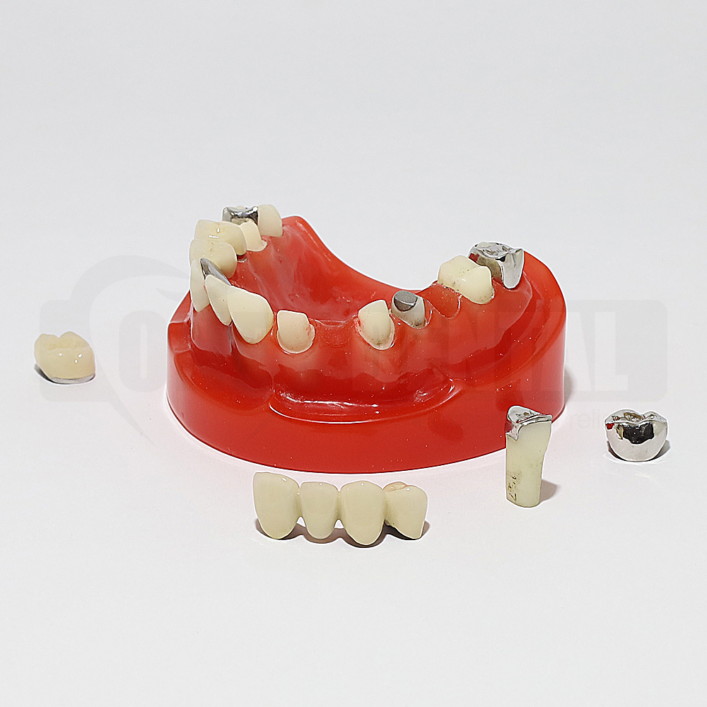 Red dental model of a lower jaw with removable teeth and several metal crowns and implants on and around the model for demonstration.